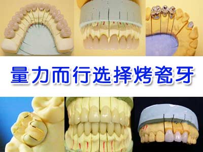 量力而行选择烤瓷牙