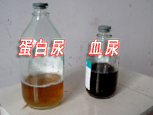 蛋白尿与血尿