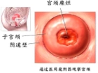 “菌毒并治”宫颈糜烂不易复发