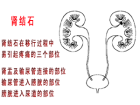 深圳五洲医院推出肾结石优免检查