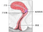 宫颈病变的防治