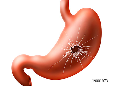 胃溃疡带来的危害是什么