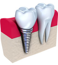 可视化种植技术