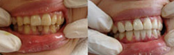 牙周炎治疗前后对比图