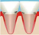 牙周炎中期症状
